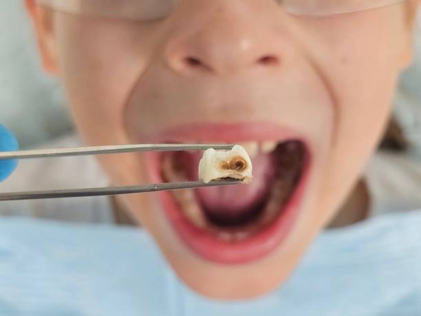 Best Urgent Tooth Repair  in Gordon, GA